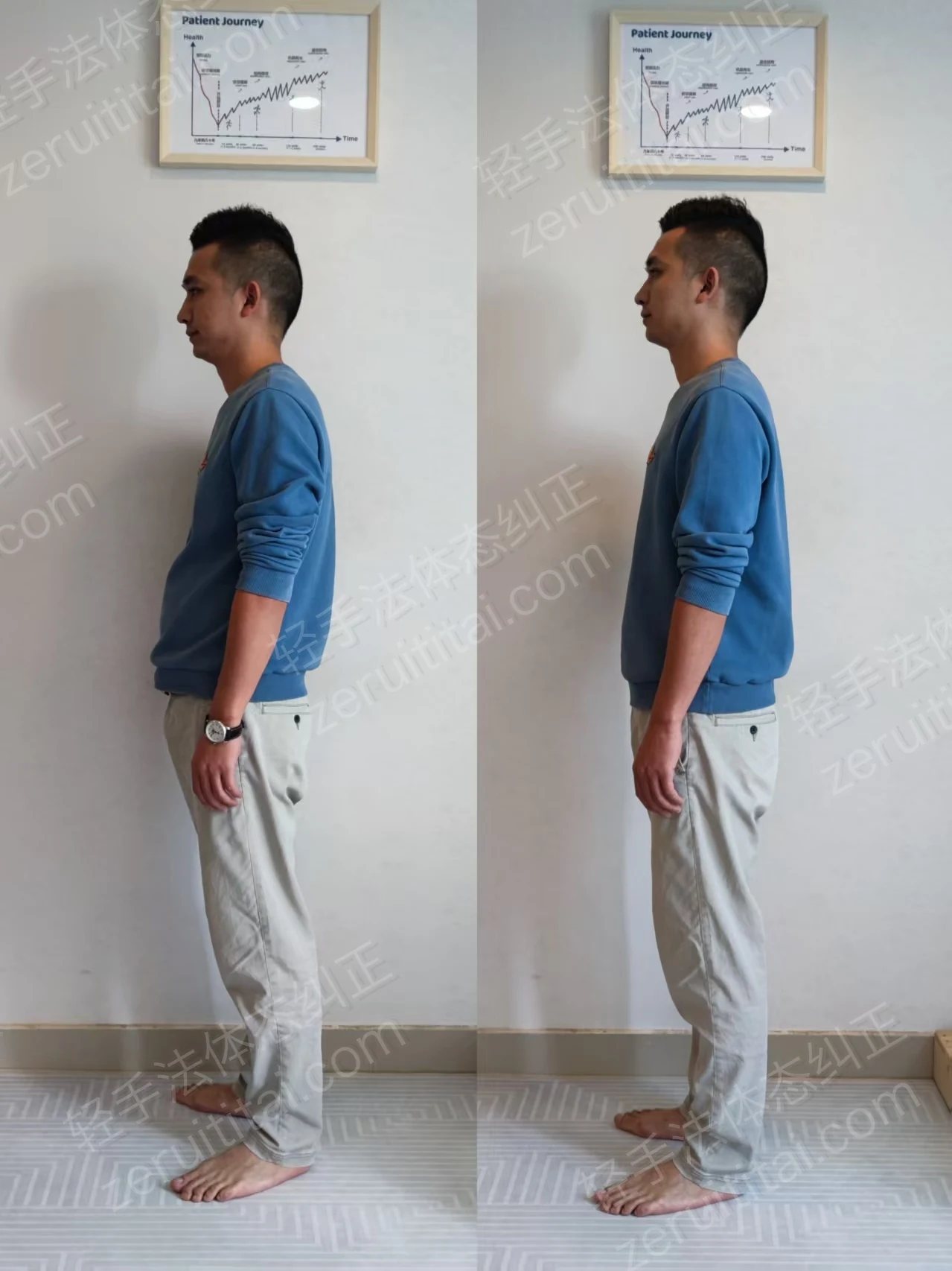 退伍兵哥哥骨盆前移｜骨盆前移、腰部紧张案例