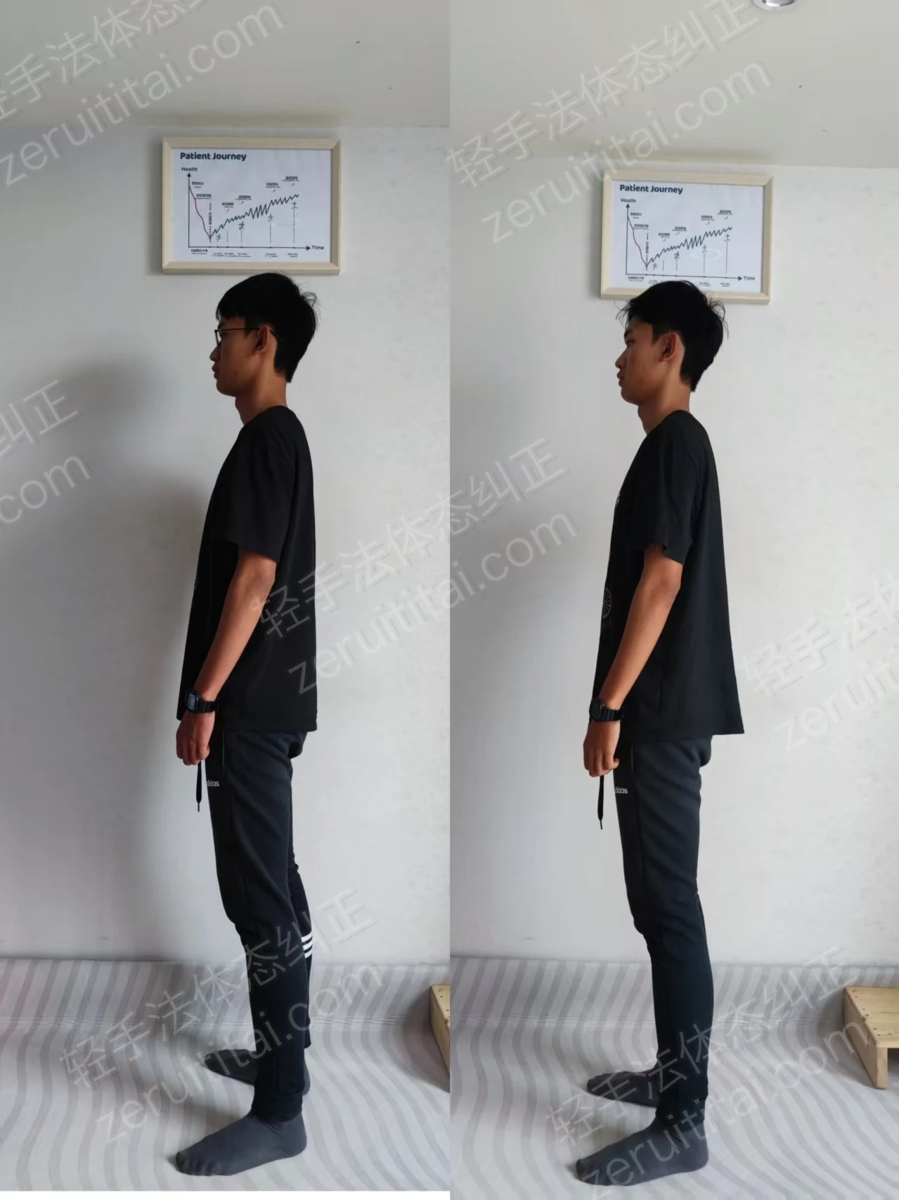 单次矫正案例对比 02