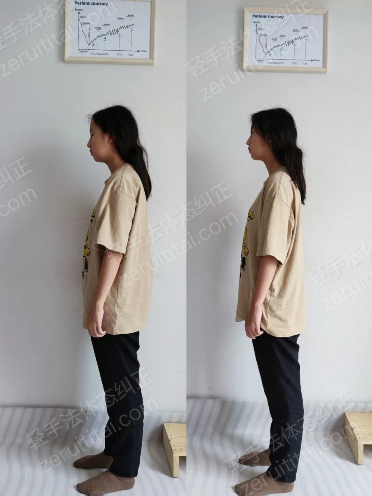 单次矫正案例对比 08