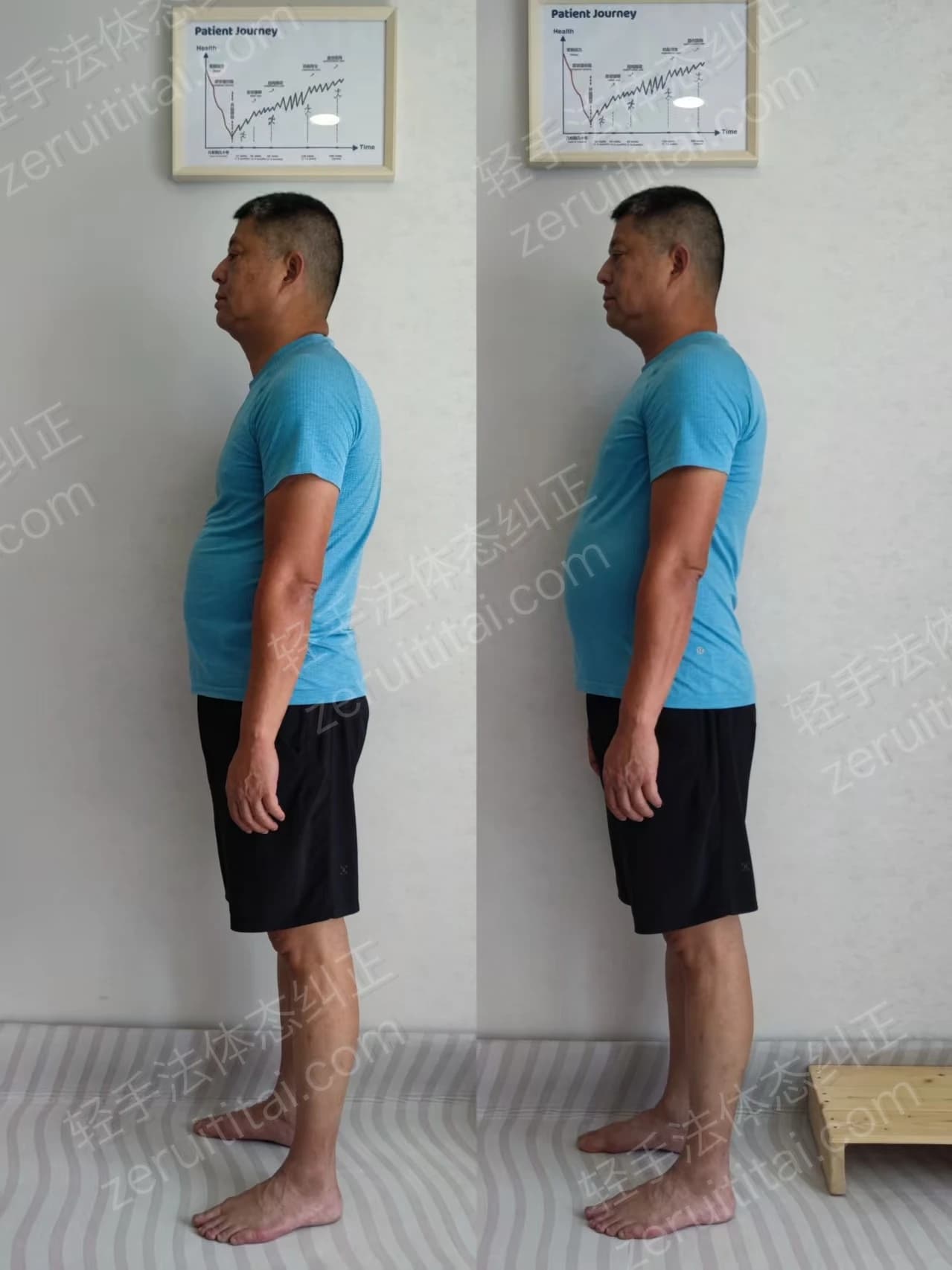 单次矫正案例对比 18