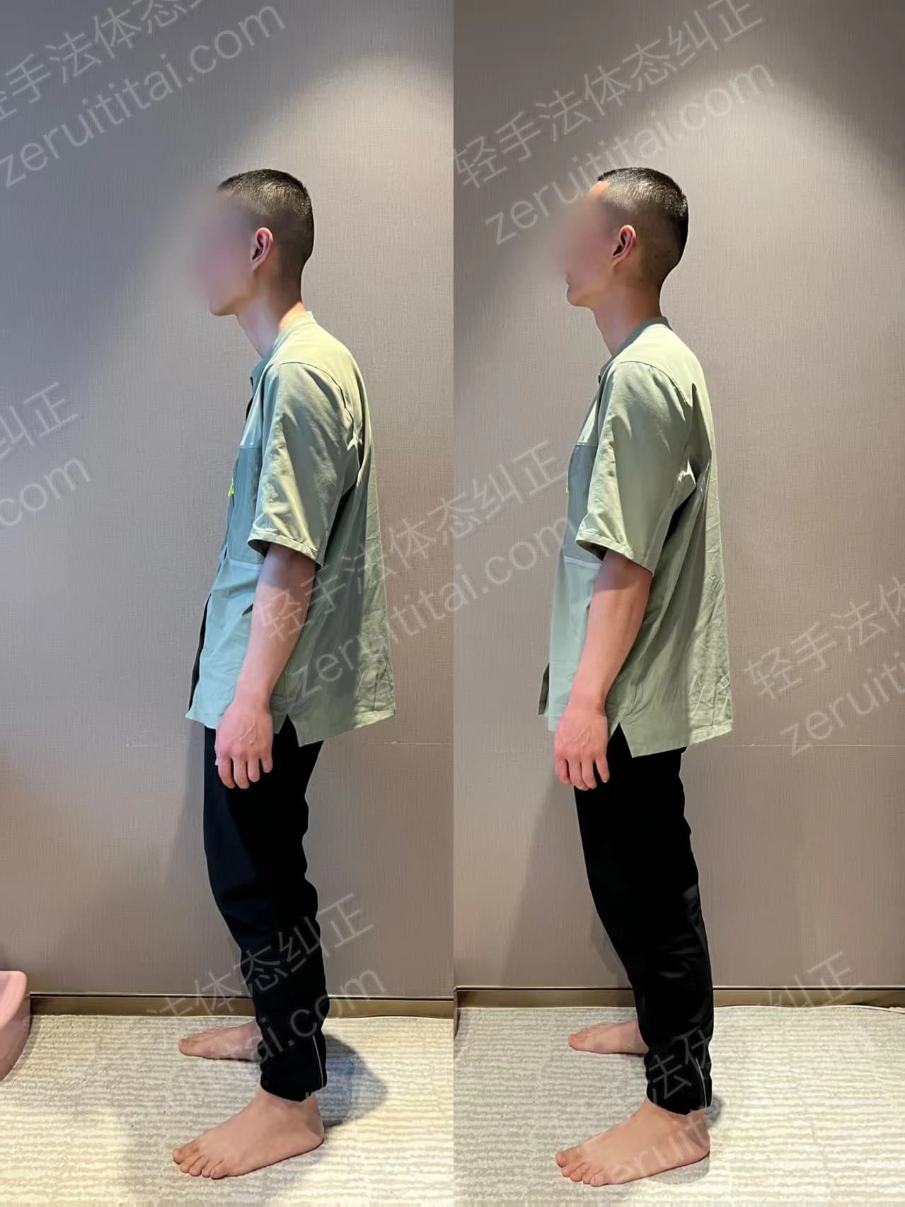 单次矫正案例对比 23