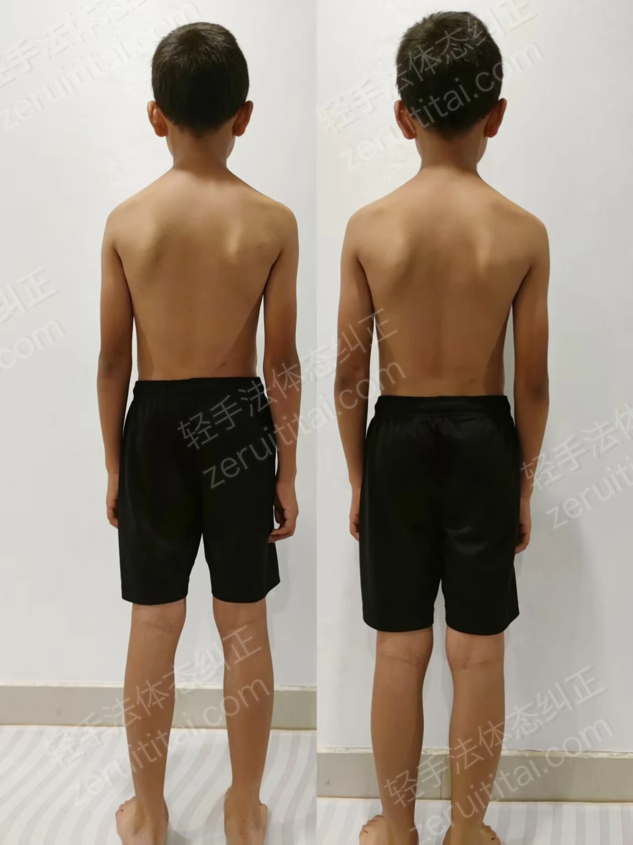 单次矫正案例对比 26