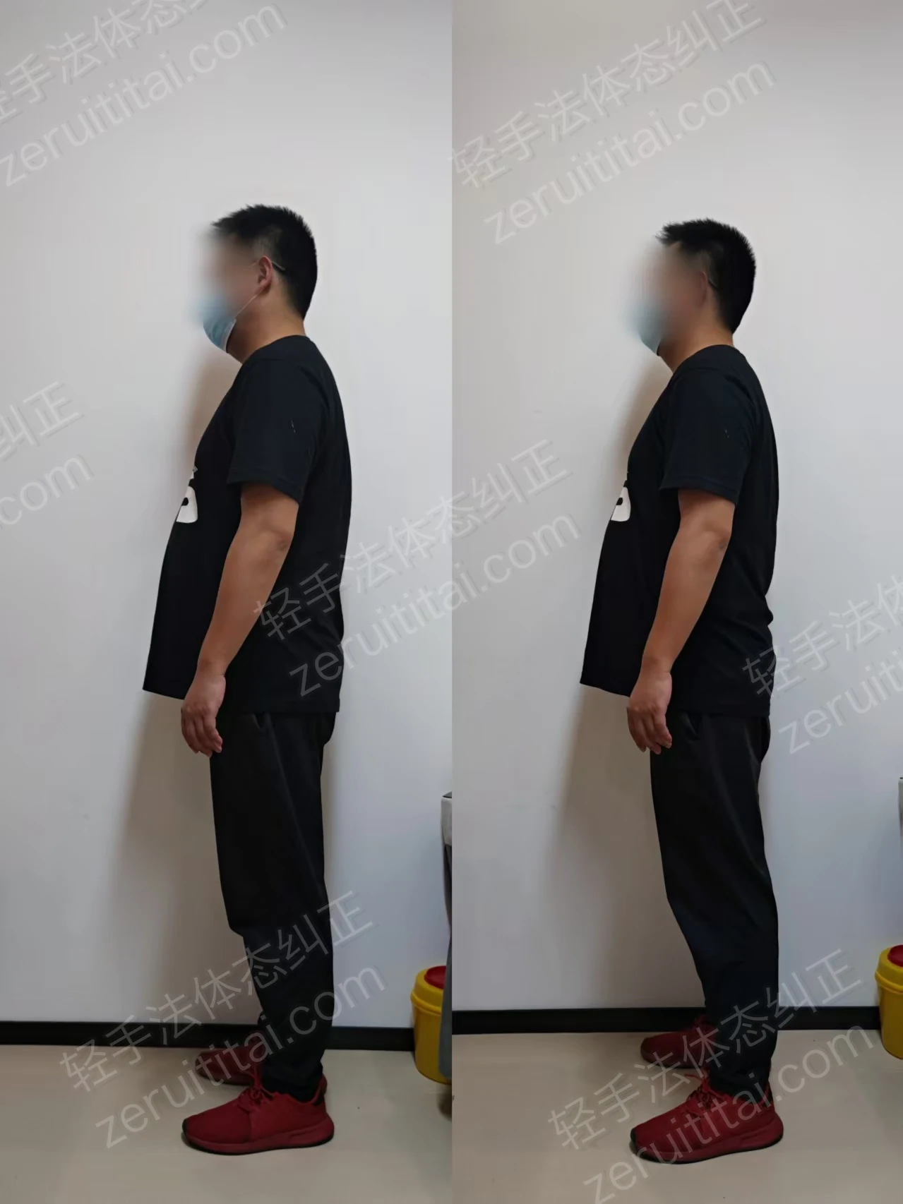 单次矫正案例对比 28