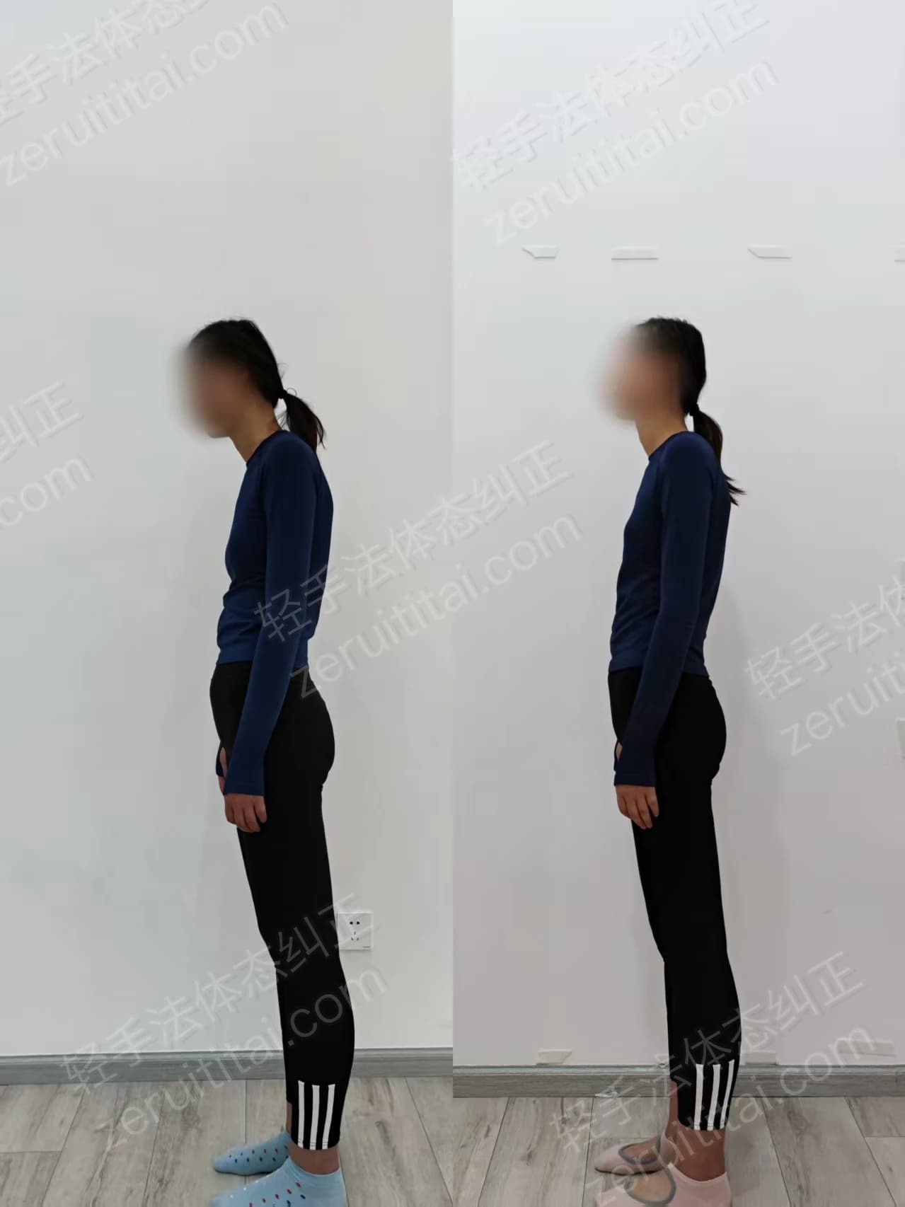 单次矫正案例对比 32