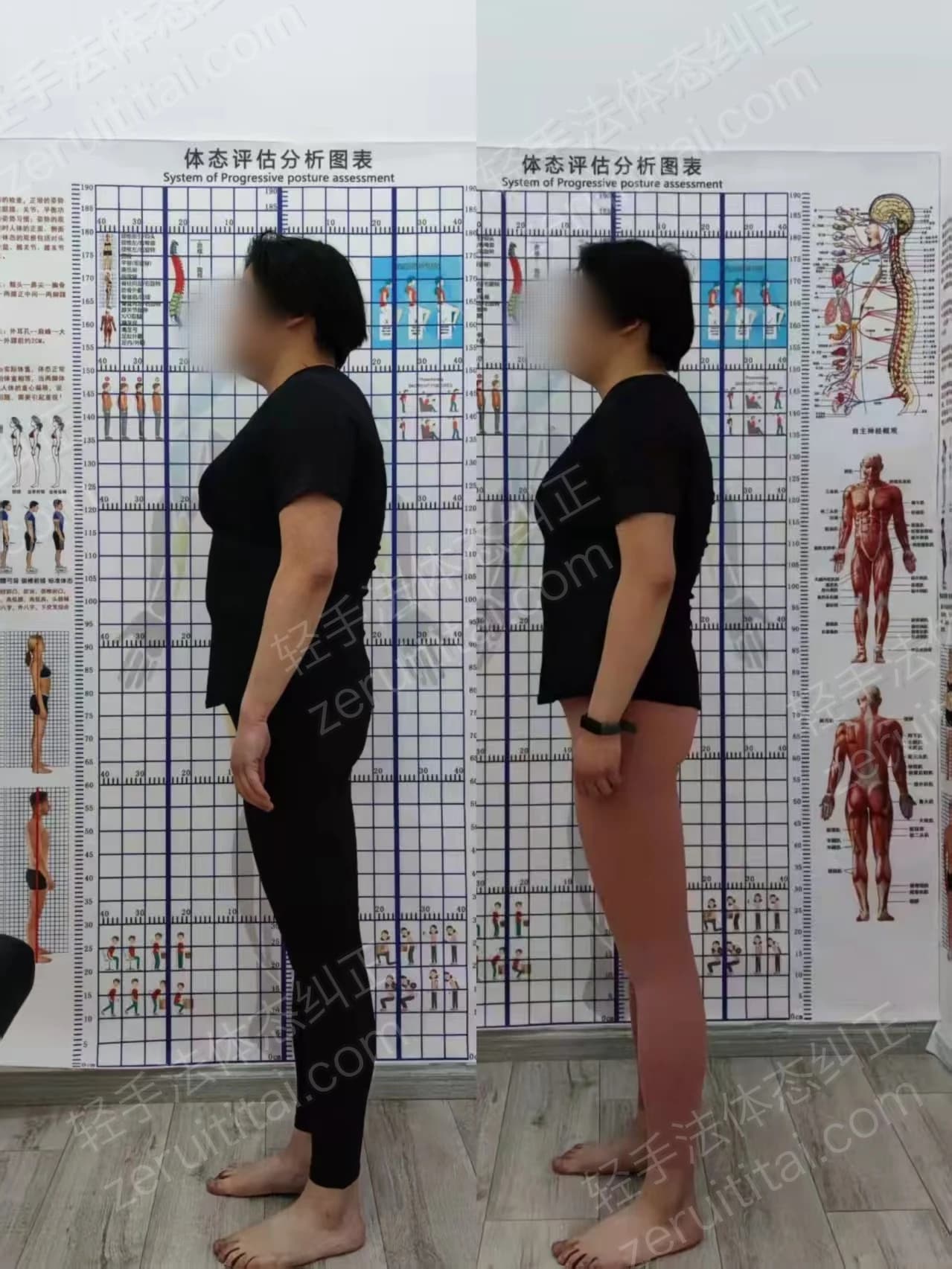 单次矫正案例对比 34