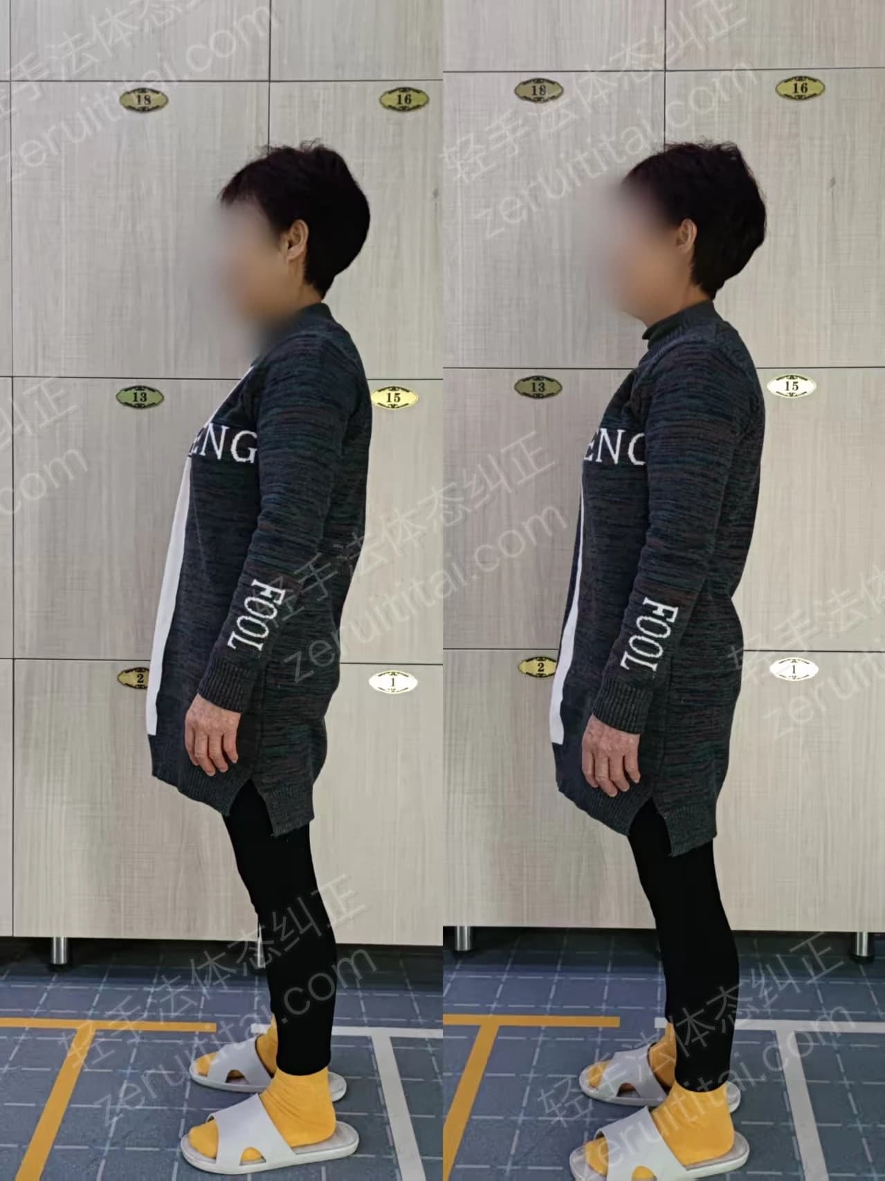 单次矫正案例对比 39