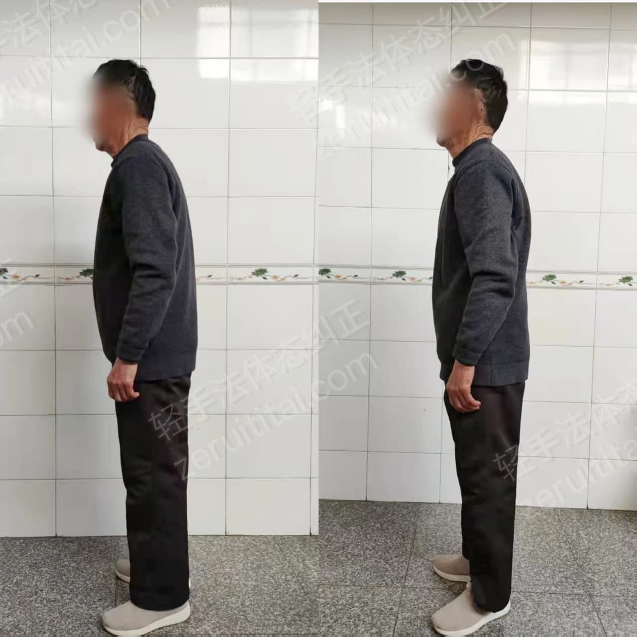 单次矫正案例对比 43