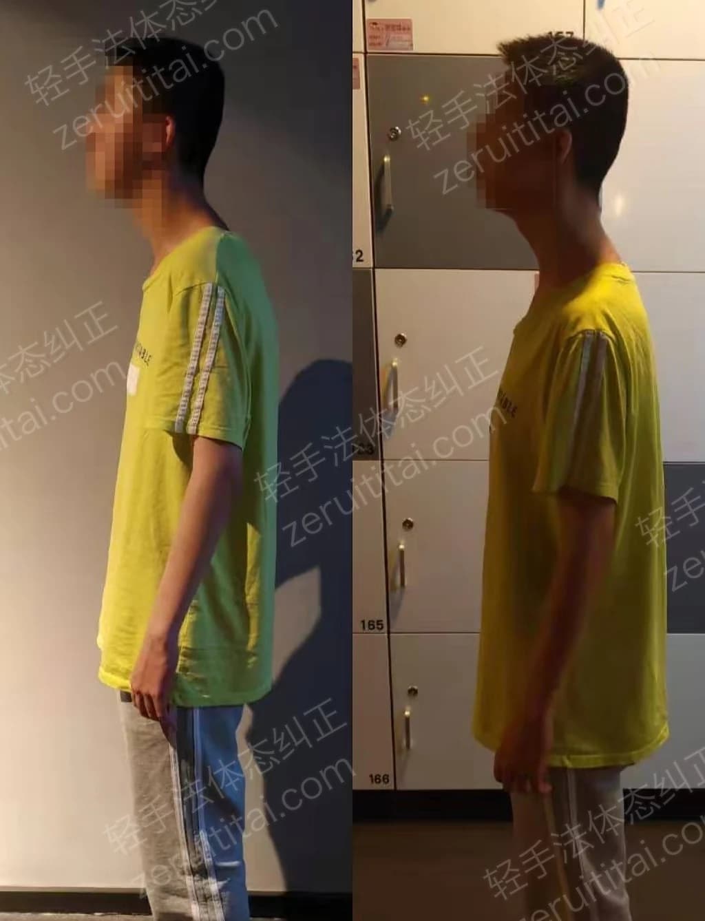 单次矫正案例对比 45