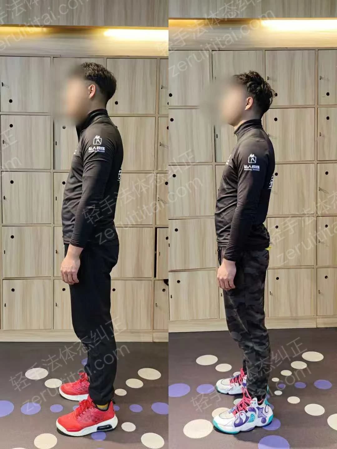 单次矫正案例对比 47