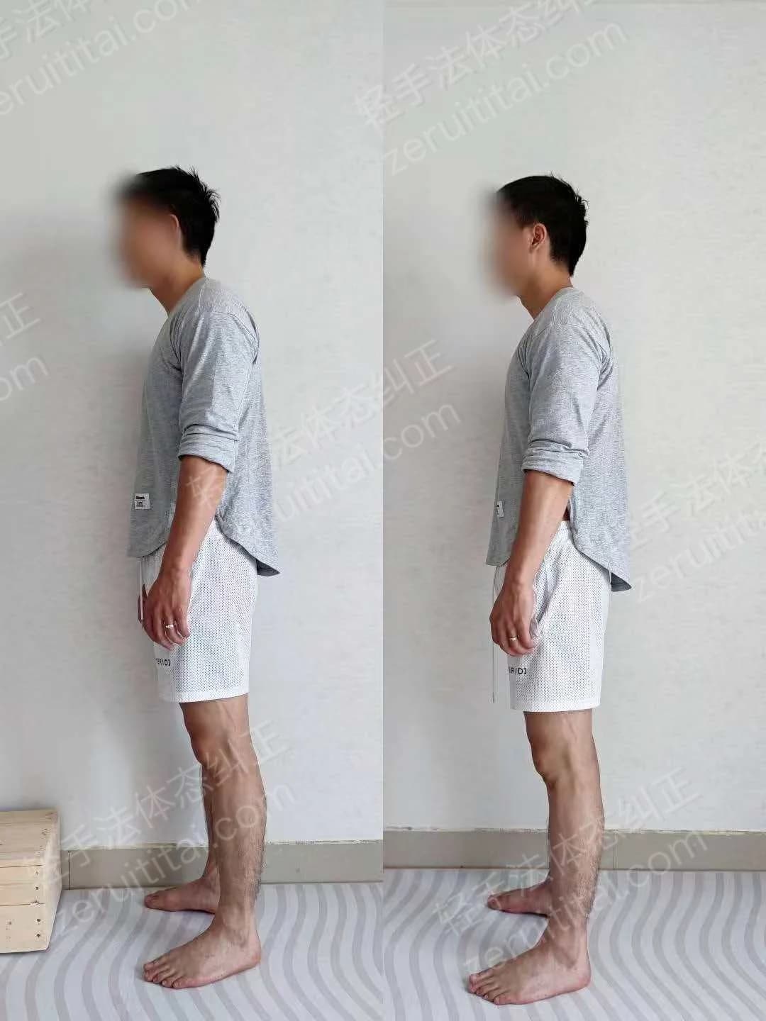 单次矫正案例对比 48