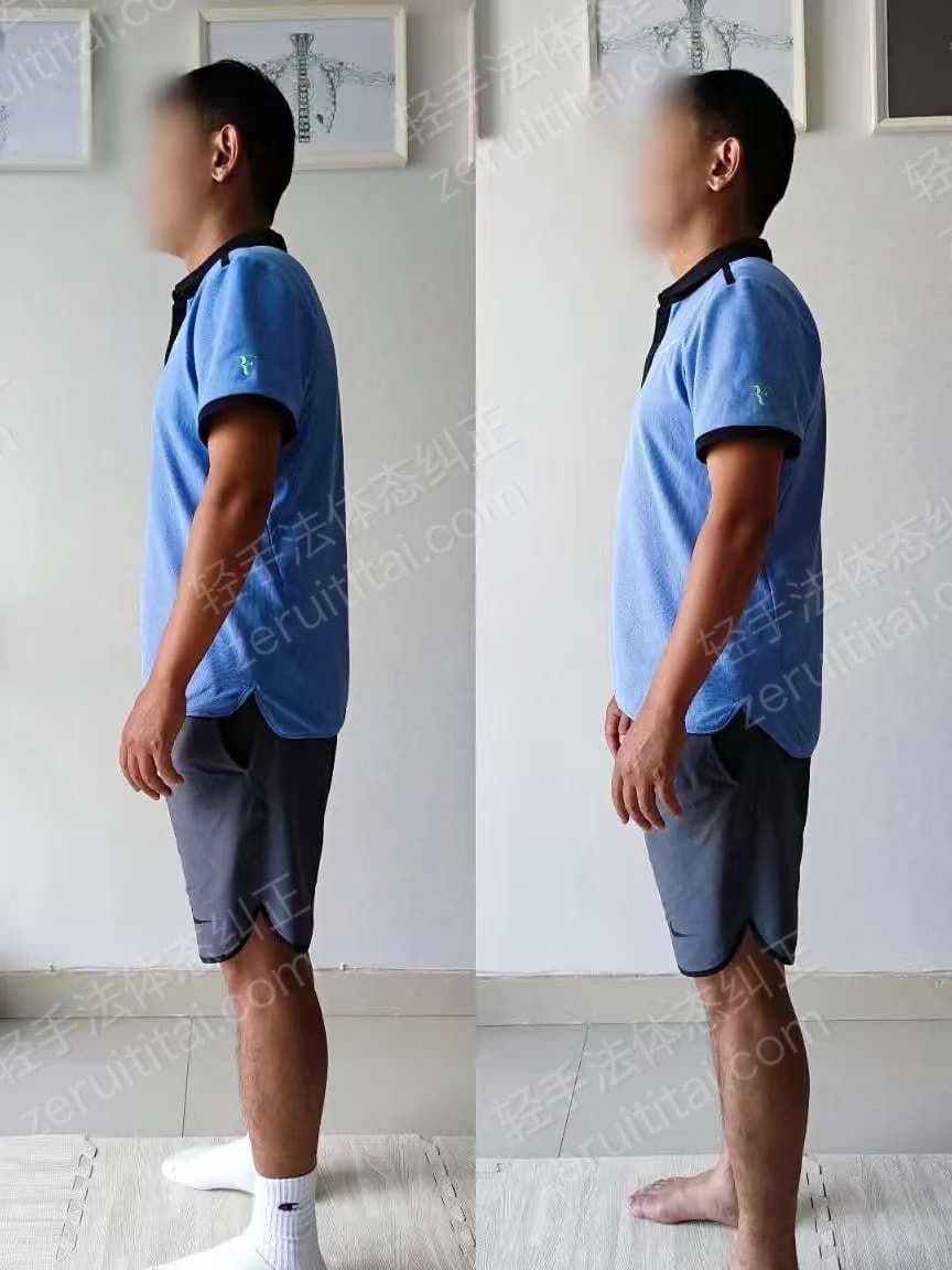 单次矫正案例对比 50