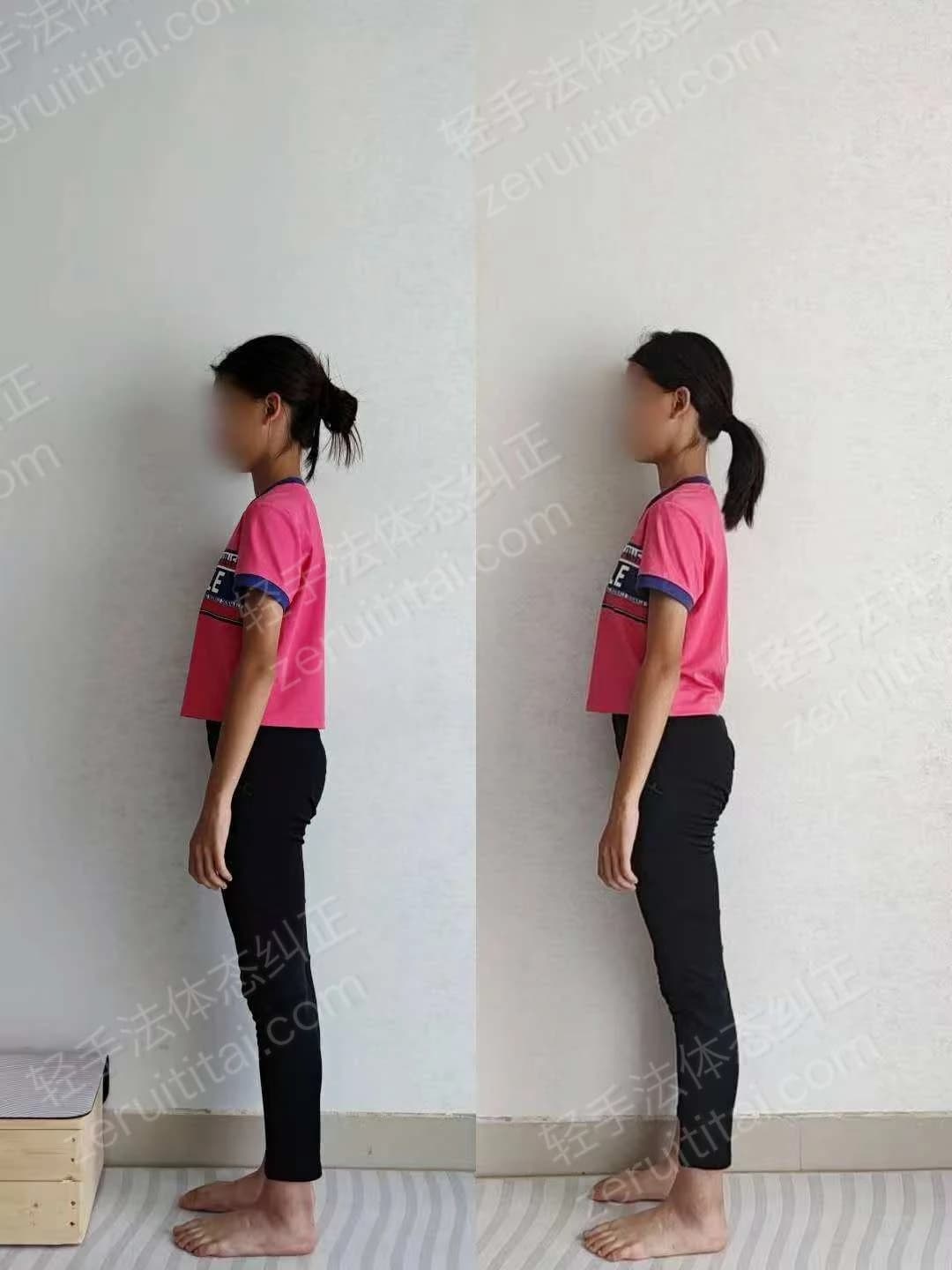 单次矫正案例对比 52