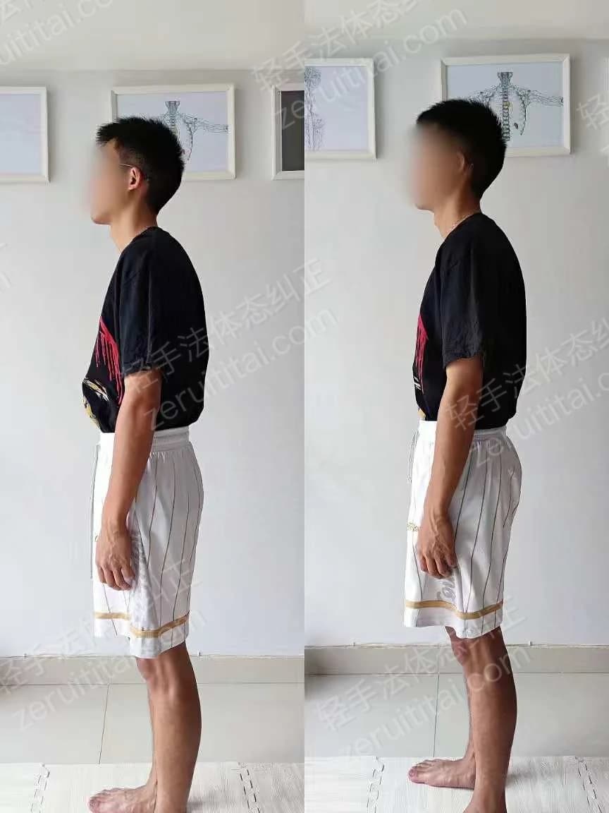 单次矫正案例对比 53