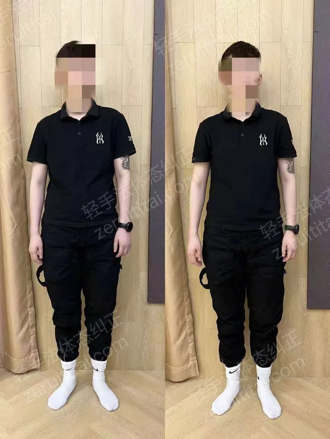 单次矫正案例对比 55