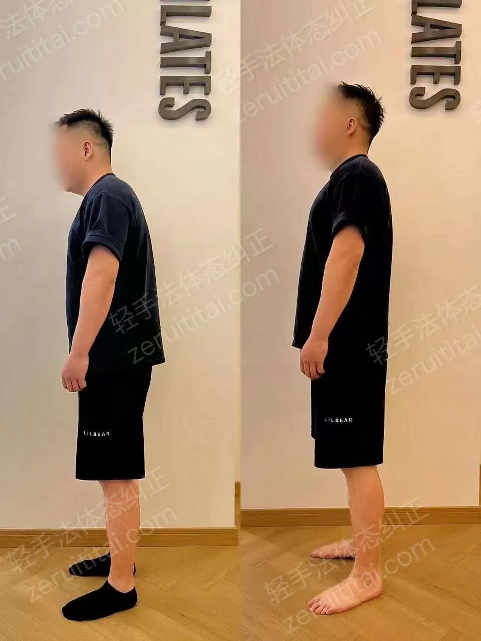 单次矫正案例对比 56