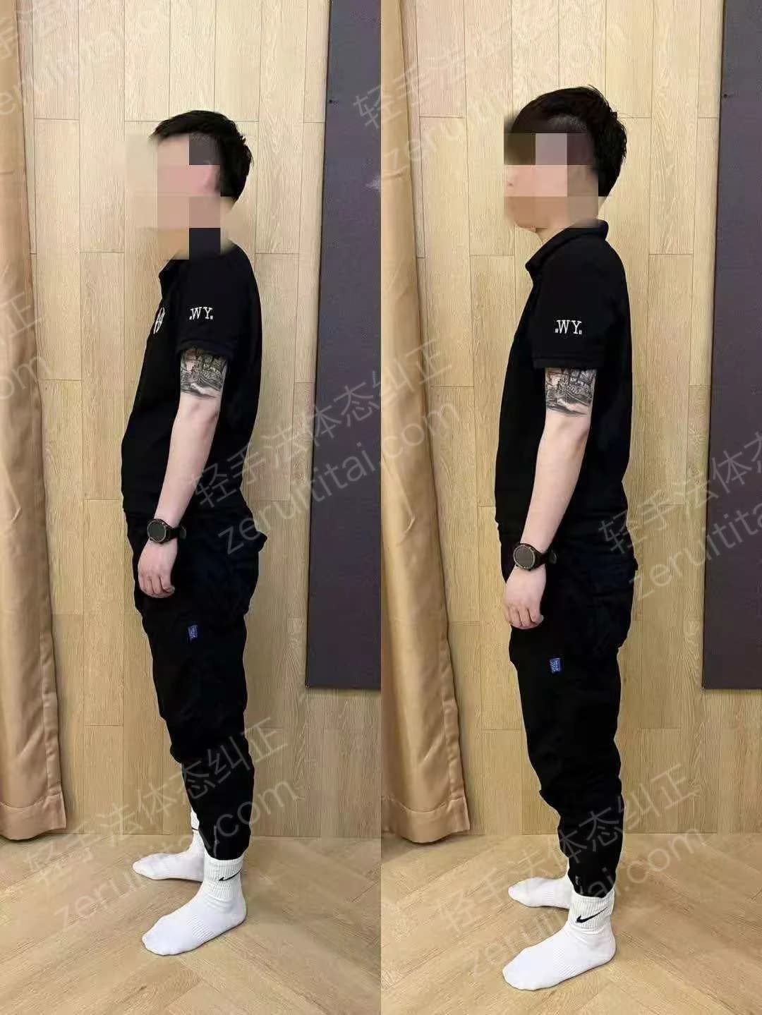 单次矫正案例对比 57