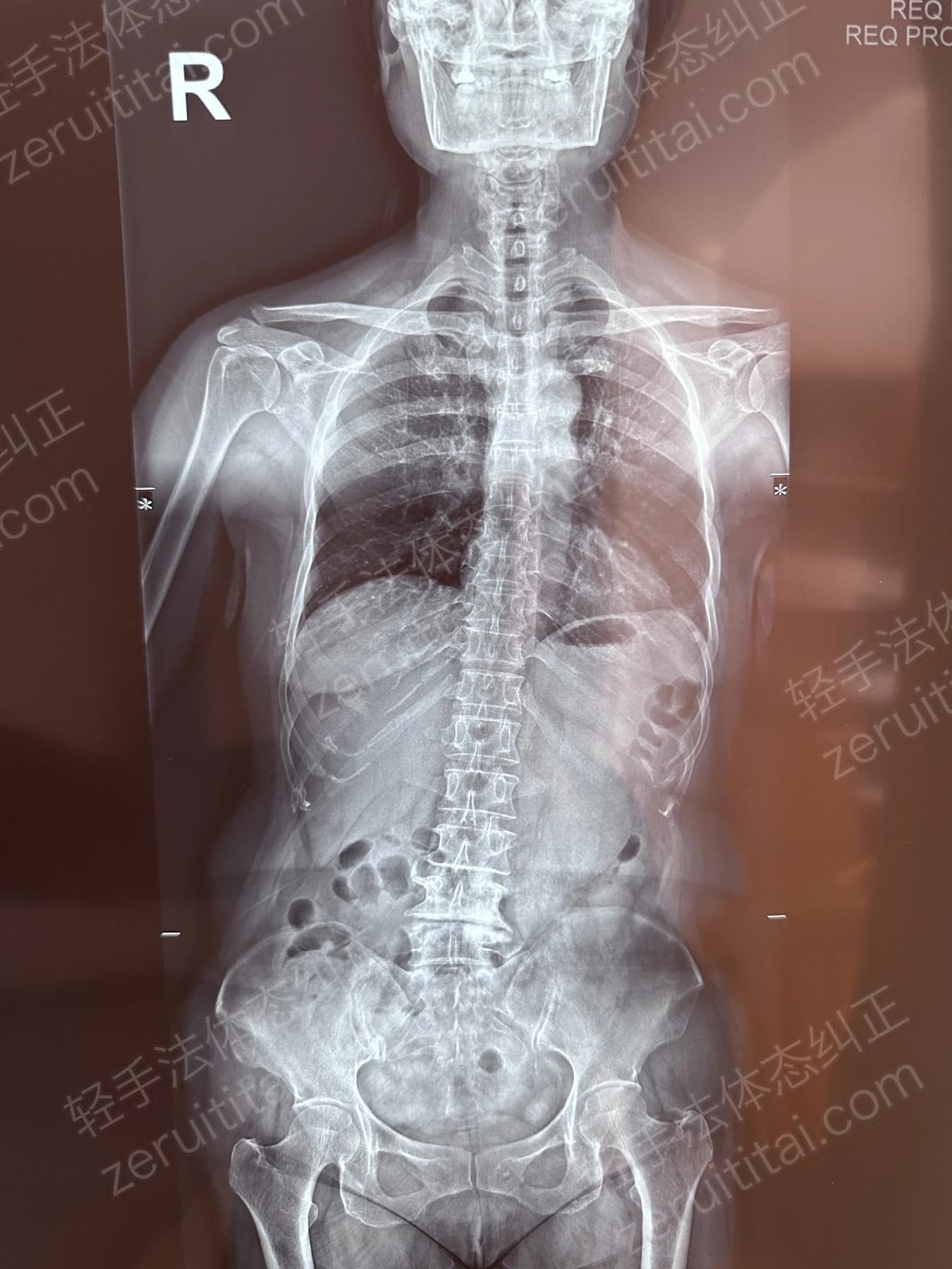 客户T阿姨 2024.01.28 正面 X光片