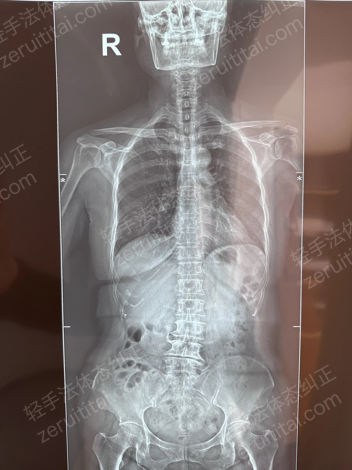 客户T阿姨 2024.12.28 正面 X光片