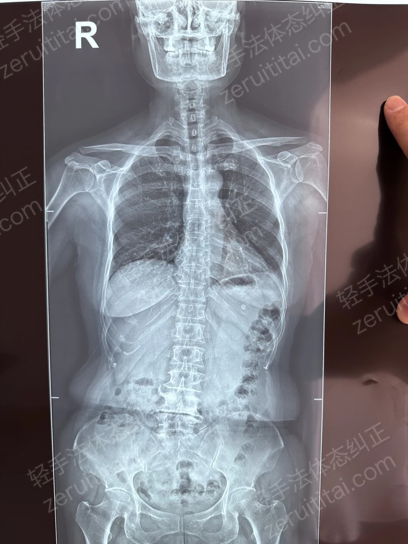 客户T阿姨 2024.08.23 正面 X光片