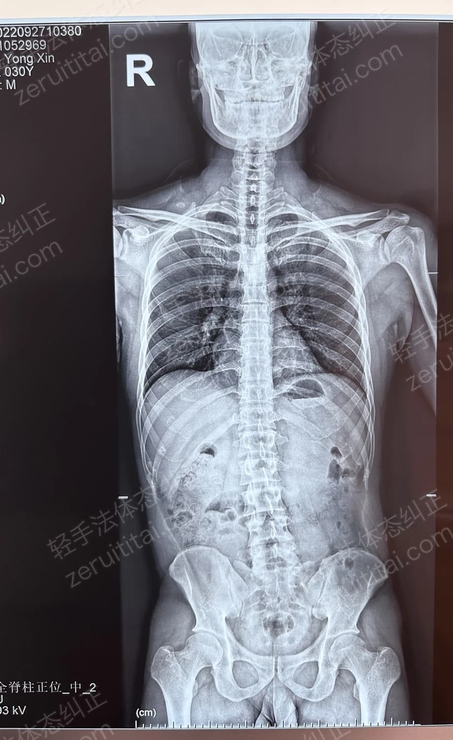 客户X老师 2022.09.27 正面 X光片