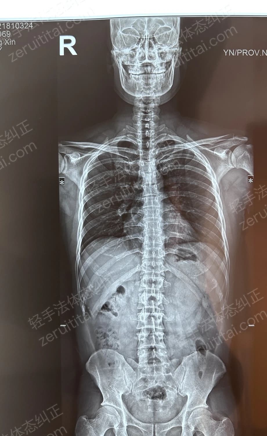 客户X老师 2024.12.18 正面 X光片
