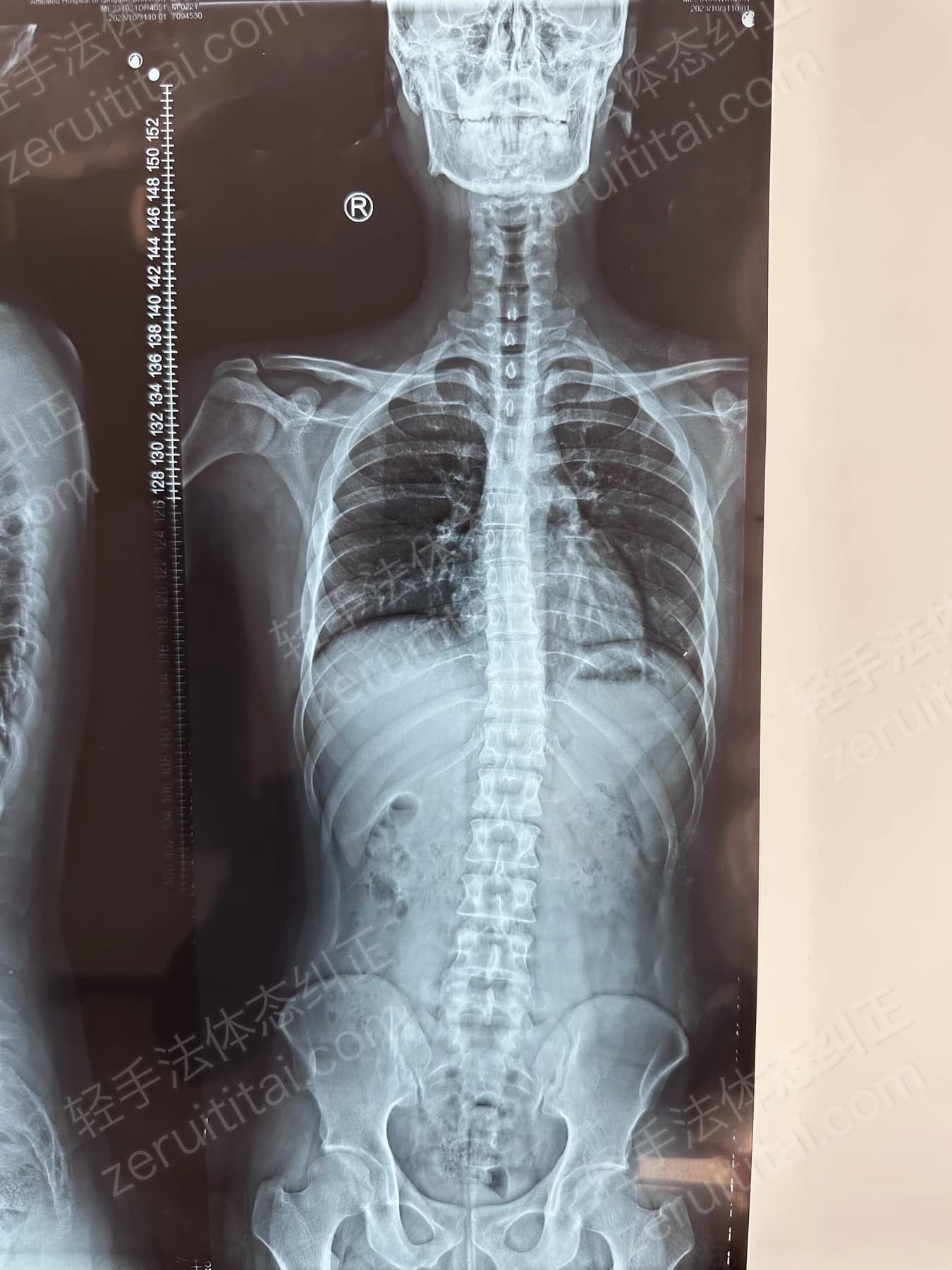 客户Z先生 2023.10.31 正面 X光片