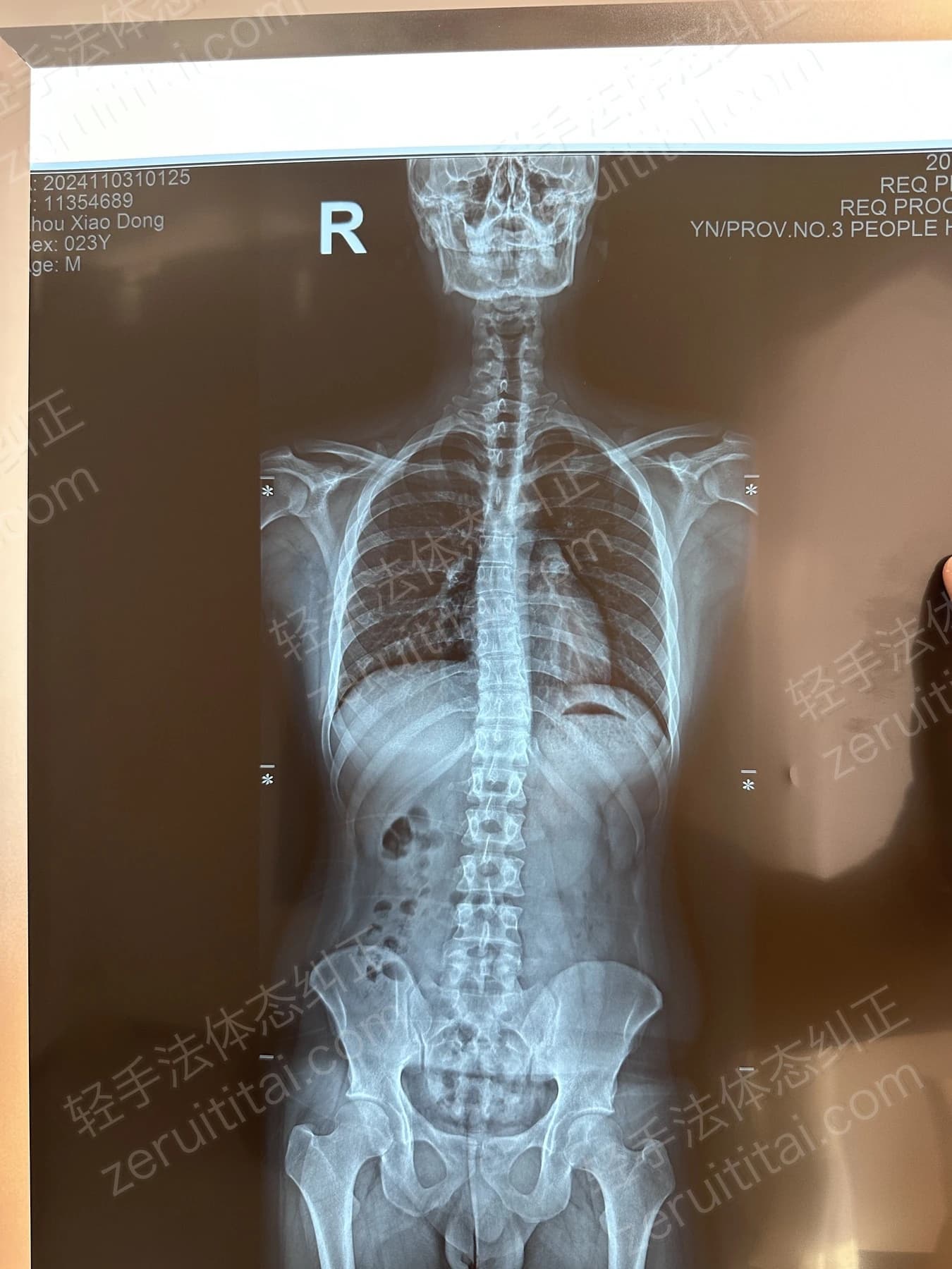 客户Z先生 2024.11.03 正面 X光片